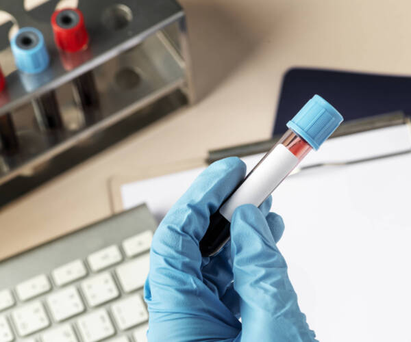Surgeon holding a blood test